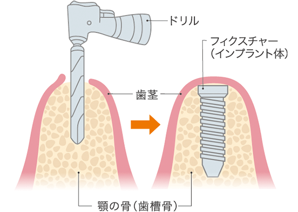 一次手術