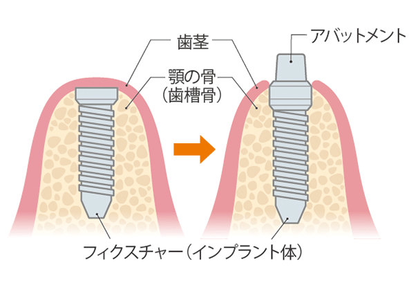 二次手術