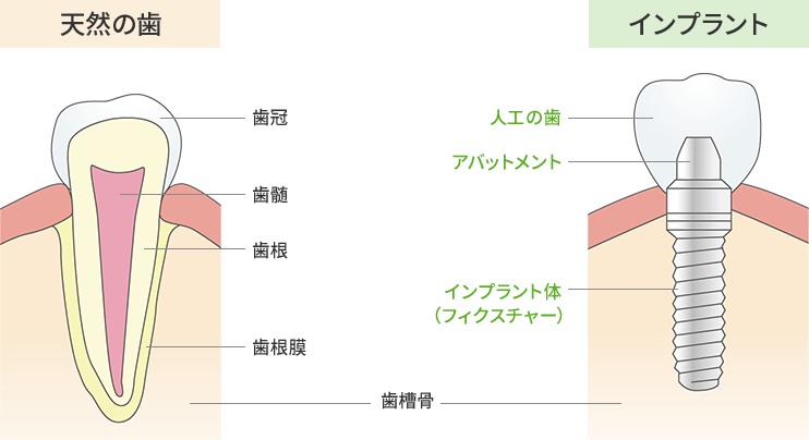 天然の歯とインプラントの構造のイラスト